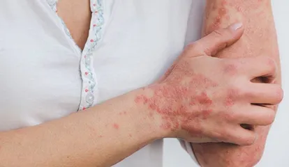 Psoriasis Clearance